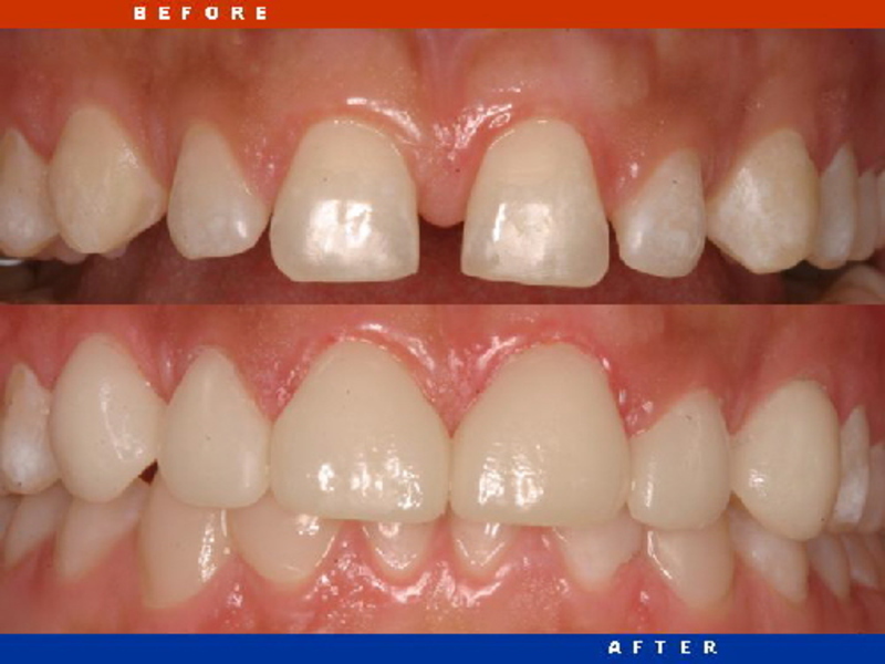 Extension of teeth on the pin and other methods, especially the use of veneers, inlays and laminirs, photo