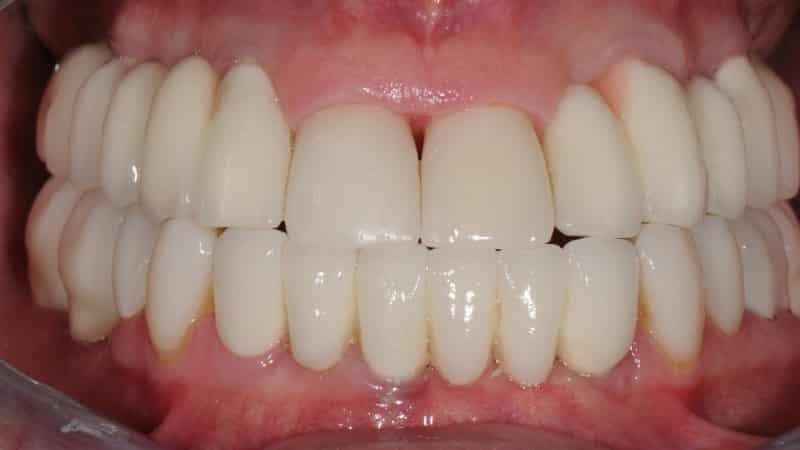 metallikeraamisissa kaksi puuttuvaa etuhampaat hammasproteesit