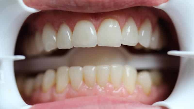 Protesi denti anteriori: Prima e Dopo