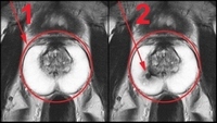 Resonancia magnética de la próstata con contraste