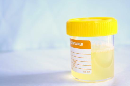 Ursachen der orange Urin: Was sind sie verbunden?