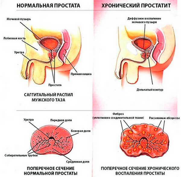 Kronisk prostatit: symptom, orsaker, diagnostiska metoder och behandling, prognostiserar Urology