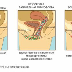 Correct microflora of the vagina
