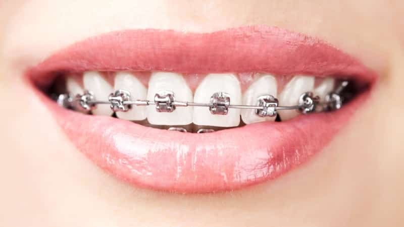 Wie tragen Zahnspange auf die Zähne, die Zähne zu richten