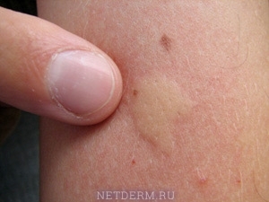 What does urticaria look like in adults?