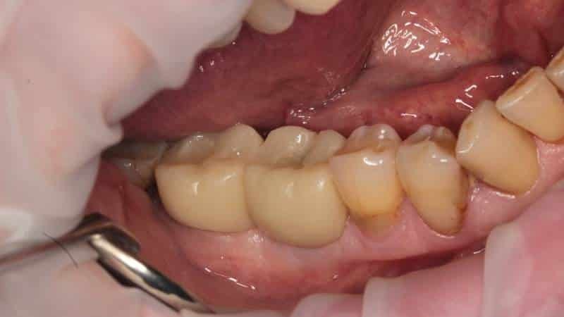 coroas de plástico em dentes posteriores