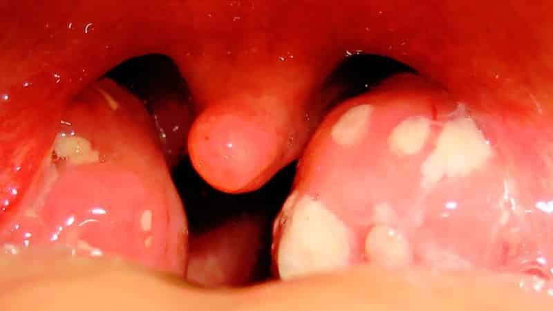 Tonsilliit - sümptomid ja ravi lastel