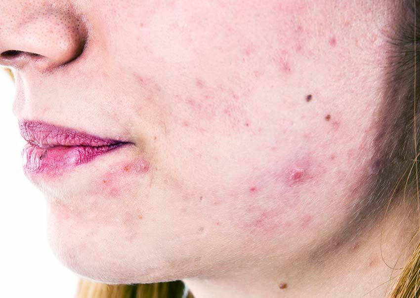Cómo tomar Trichopol de acné en la cara?