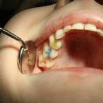 Pulpitisa mliječni zubi - liječenje