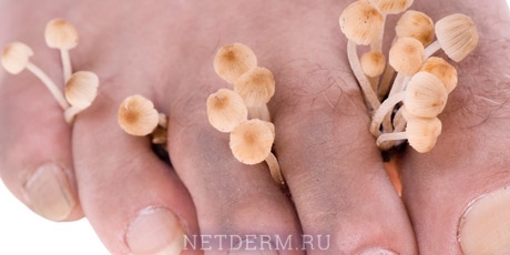 ¿Qué barniz de un hongo de uñas es mejor y más eficaz para el tratamiento?