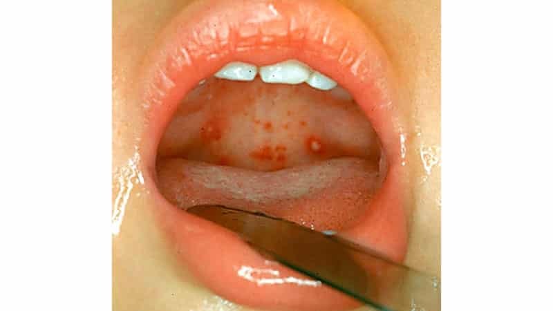 På ganen sår i munden: hvad og hvordan man behandler