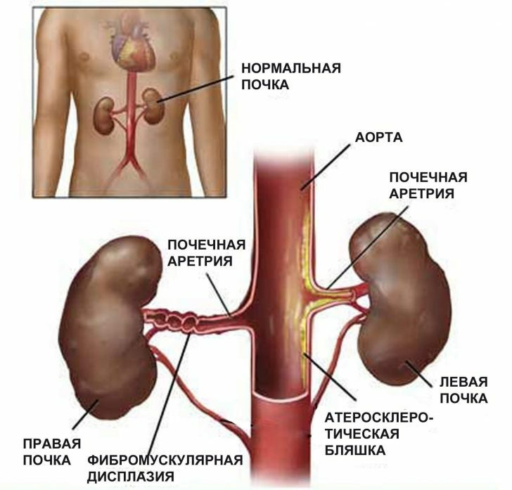 Kidney pressure: symptoms and treatment