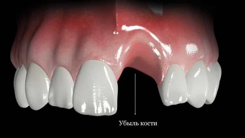 Etter en tid etter tann implantat kan plasseres