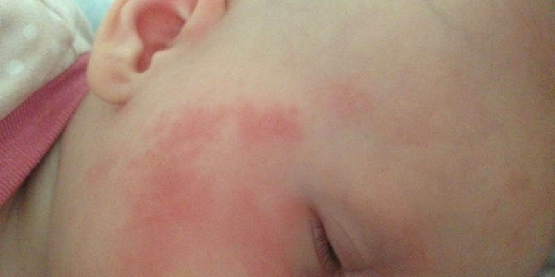 En la piel manchas rojas de alergias