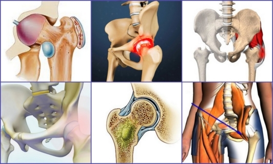 Los síntomas de la paciente bursitis de la cadera
