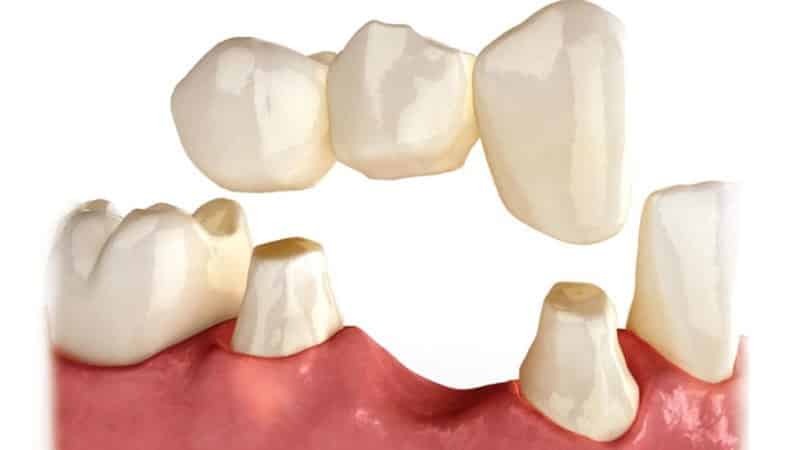 niet verwijderbare kunstgebitten in de afwezigheid van tanden