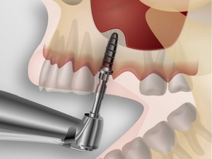 Když je požadovaný výkon z kostní tkáně v zubní zubní implantáty, zejména tohoto postupu, výhody i nevýhody