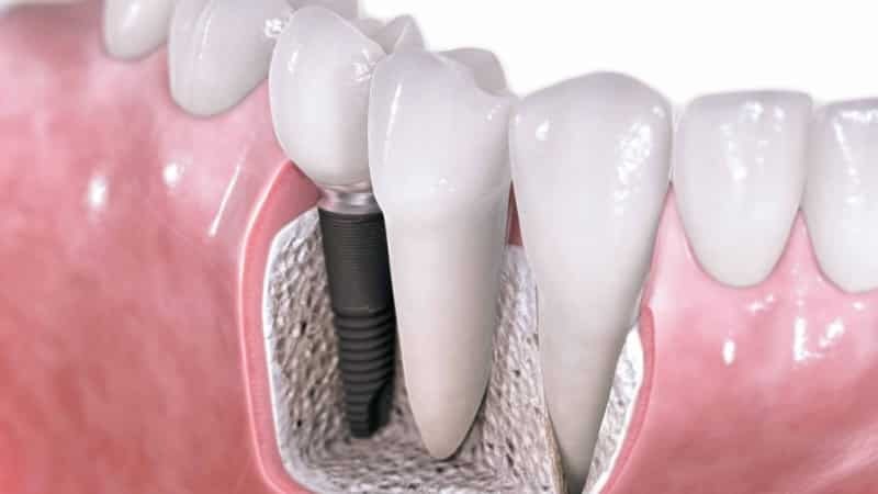 que implante é melhor colocar sobre os dentes de mastigação