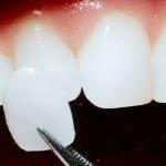 Anbringelse og fast Lumineers til tennene