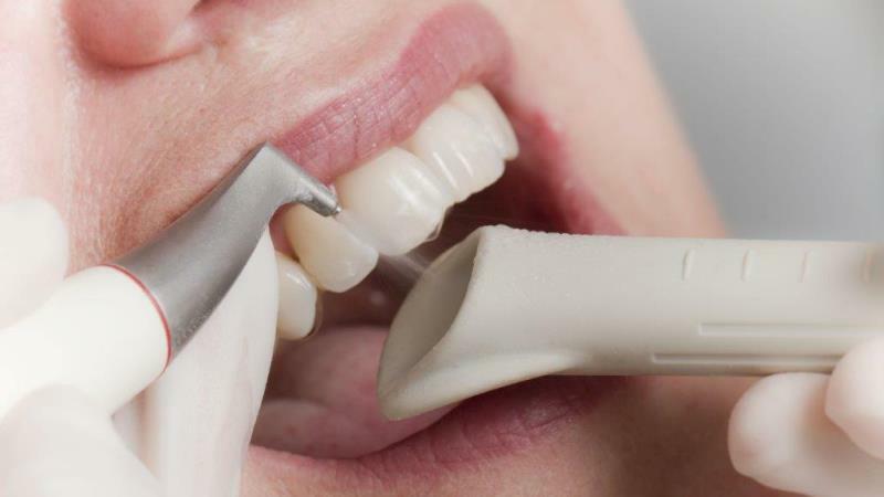 Borttagning av dentala insättningar med ultraljud och enhets AirFlow