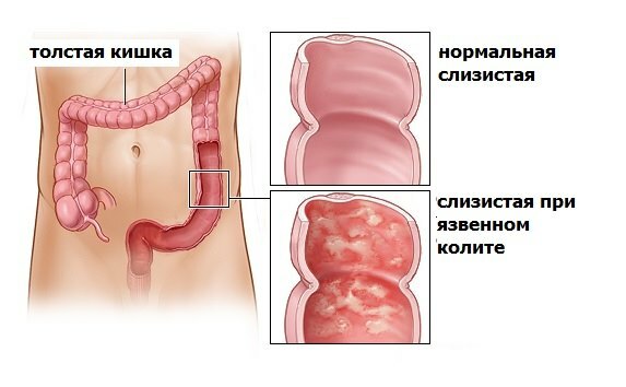 Colitis-intestine