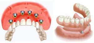 Prosthetic dentistry: types of dentistry and prices for dentures in Moscow
