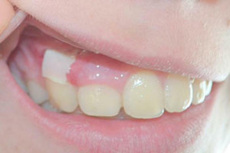 Drainage in das Zahnfleisch: es sieht aus wie( Foto) und was zu tun ist, wenn Sie fallen gelassen