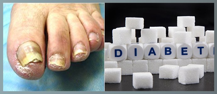 Huba na nechty pri diabetes mellitus: liečba, vlastnosti kurzu