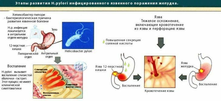 La úlcera péptica: formas, causas y síntomas
