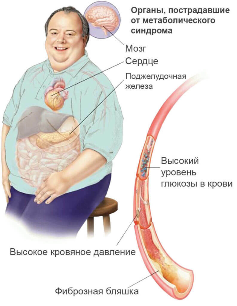 Metabolisches Syndrom: Diagnose, Behandlung, Übergewicht und MS bei Frauen und Männern
