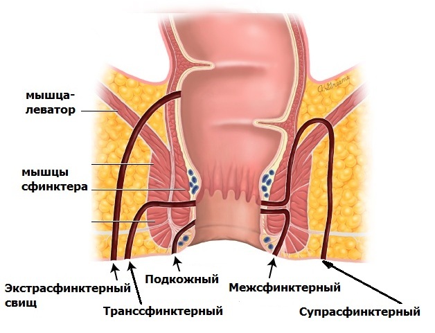De oorzaken en behandeling van de fistel van de rectum