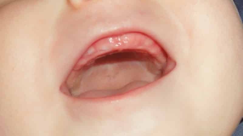 quanto latte denti nei bambini