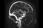 Angiography of cerebral vessels