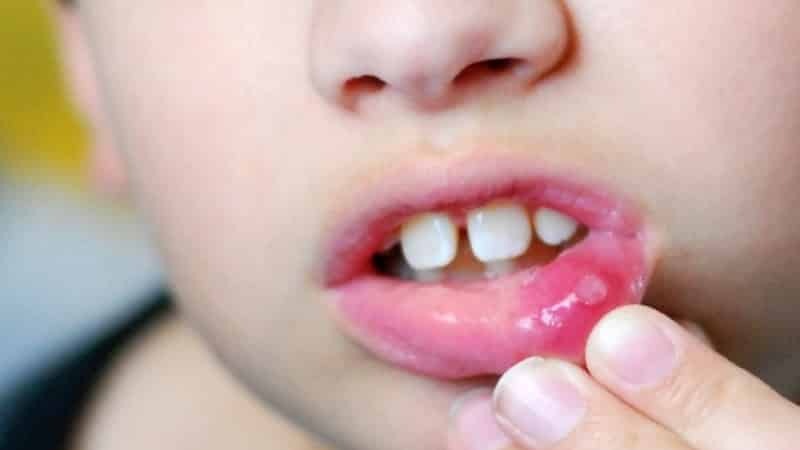 Aphthous stomatitis in children: symptoms and treatment