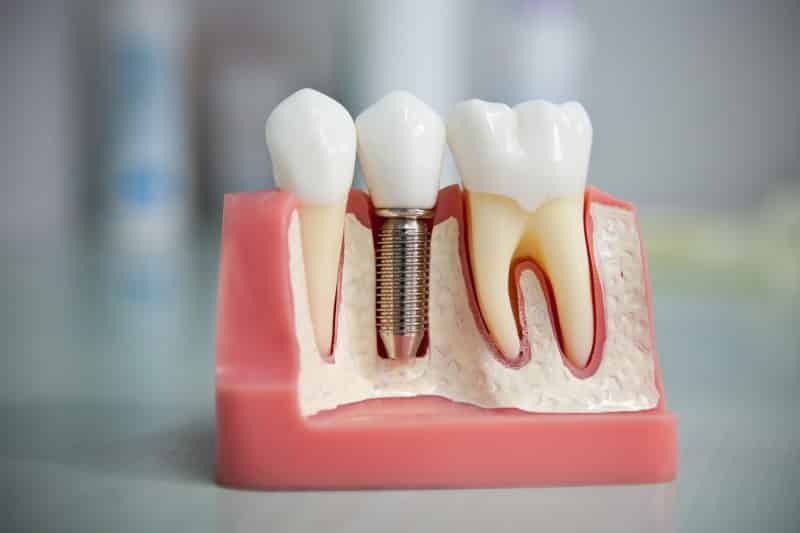 implantasjon av proteser tannbehandling