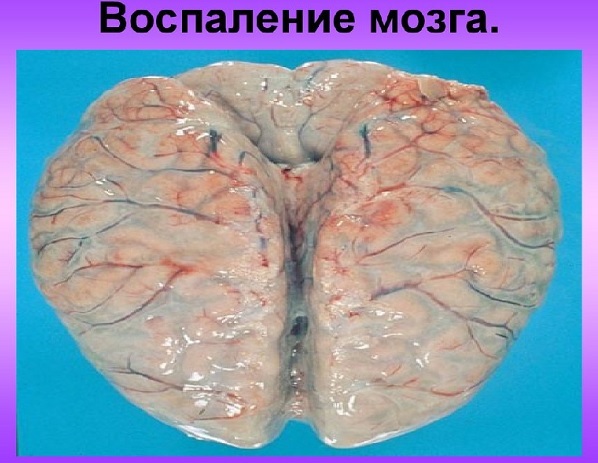 Inflamación de la corteza cerebral y membranas