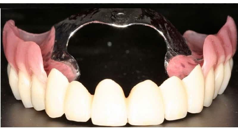 protetikk med periodontitt typer protese som bedre bilder