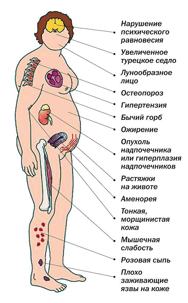 Hipotalámicas síndrome: síntomas, particularmente durante la pubertad, tratamiento