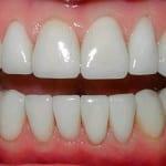 Installer skallfasetter på tennene