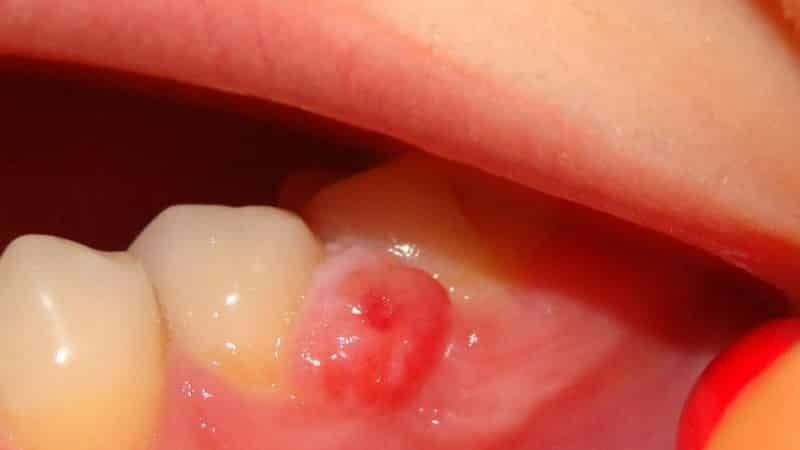 Geschwür auf dem Zahnfleisch des Kindes