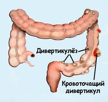 Sigmoid diverticulosis