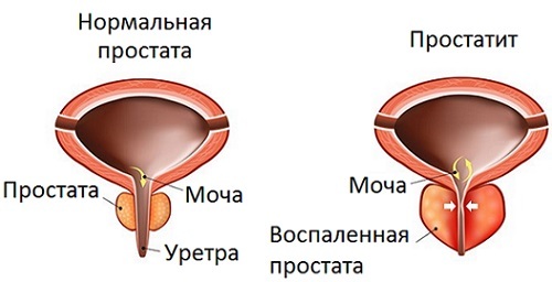 ¿Cómo encontrar e identificar el desarrollo de la patología de próstata