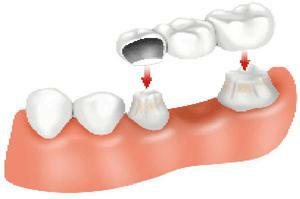 Quais são os diferentes tipos de prótese dentária fixa, tipos de construção, as vantagens e desvantagens de cada