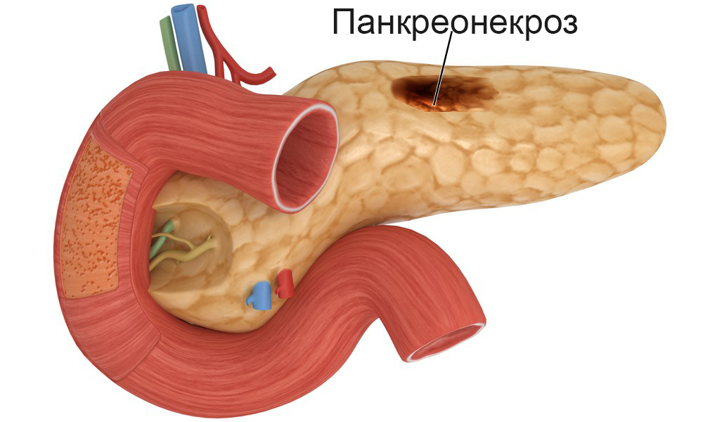 Bukspottkörtelnekros i bukspottkörteln: orsaker, symptom, behandling