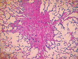 Histiocytose foto