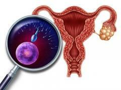 iperfunzione ovarico