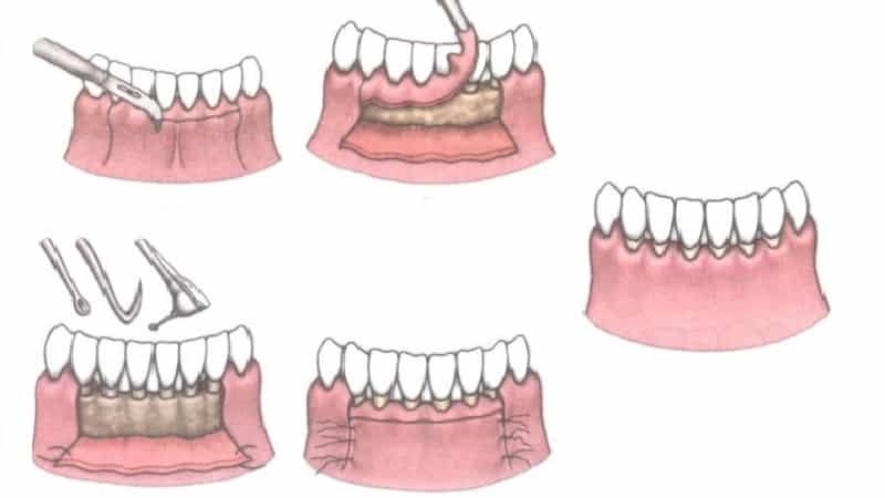 wie die Tasche in dem Zahnfleisch zwischen den Zähnen zu behandeln