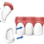 Veneers on the teeth - installation diagram