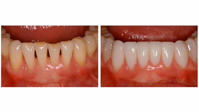 Lumineers de tanden: wat het is, voor en na foto's