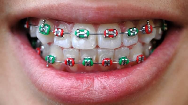 wie viel sind Klammern an adulten Zähne